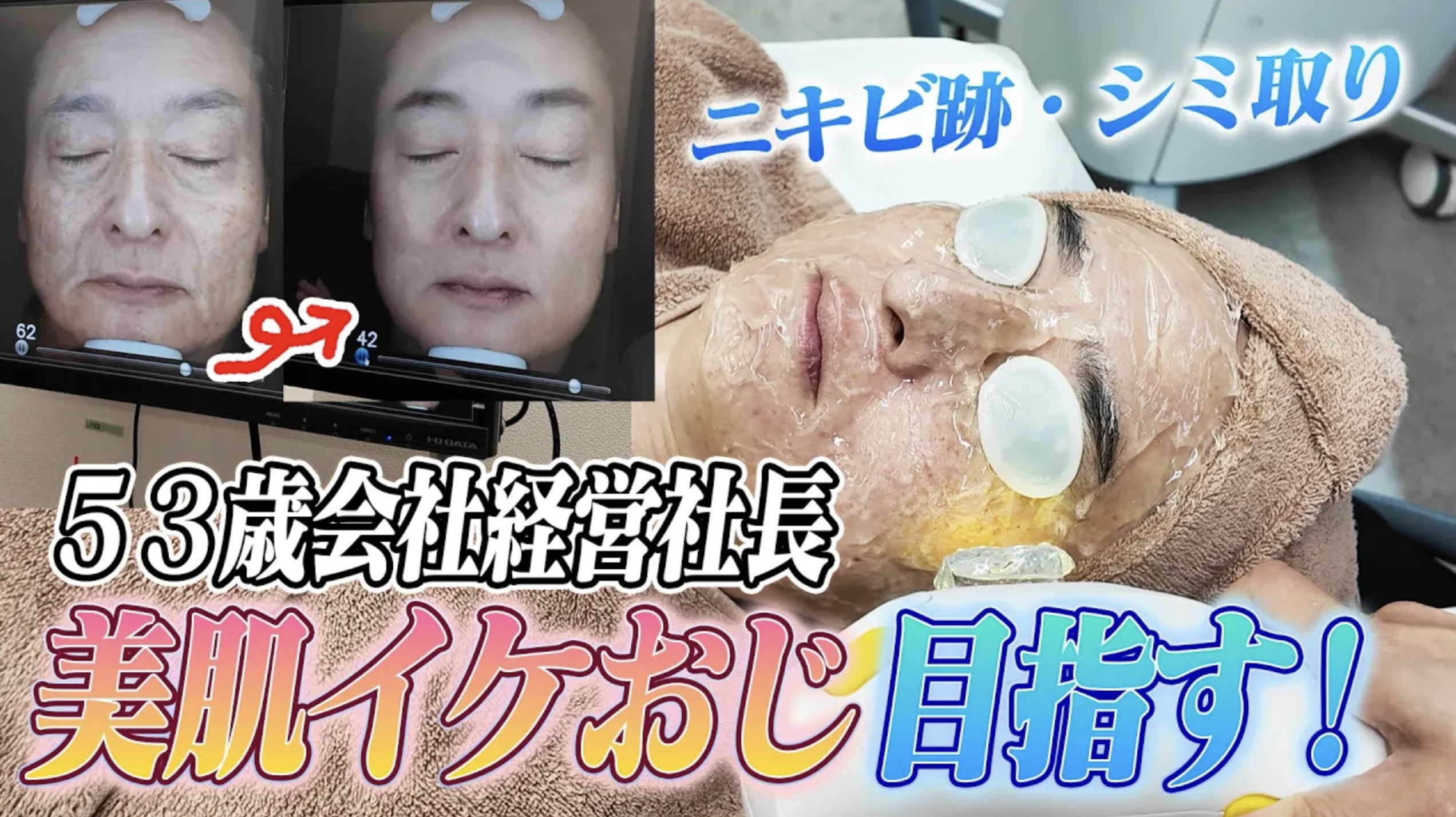 53歳社長が初挑戦！美容皮膚科でシミ・ニキビ跡をIPL治療してみた体験レポート