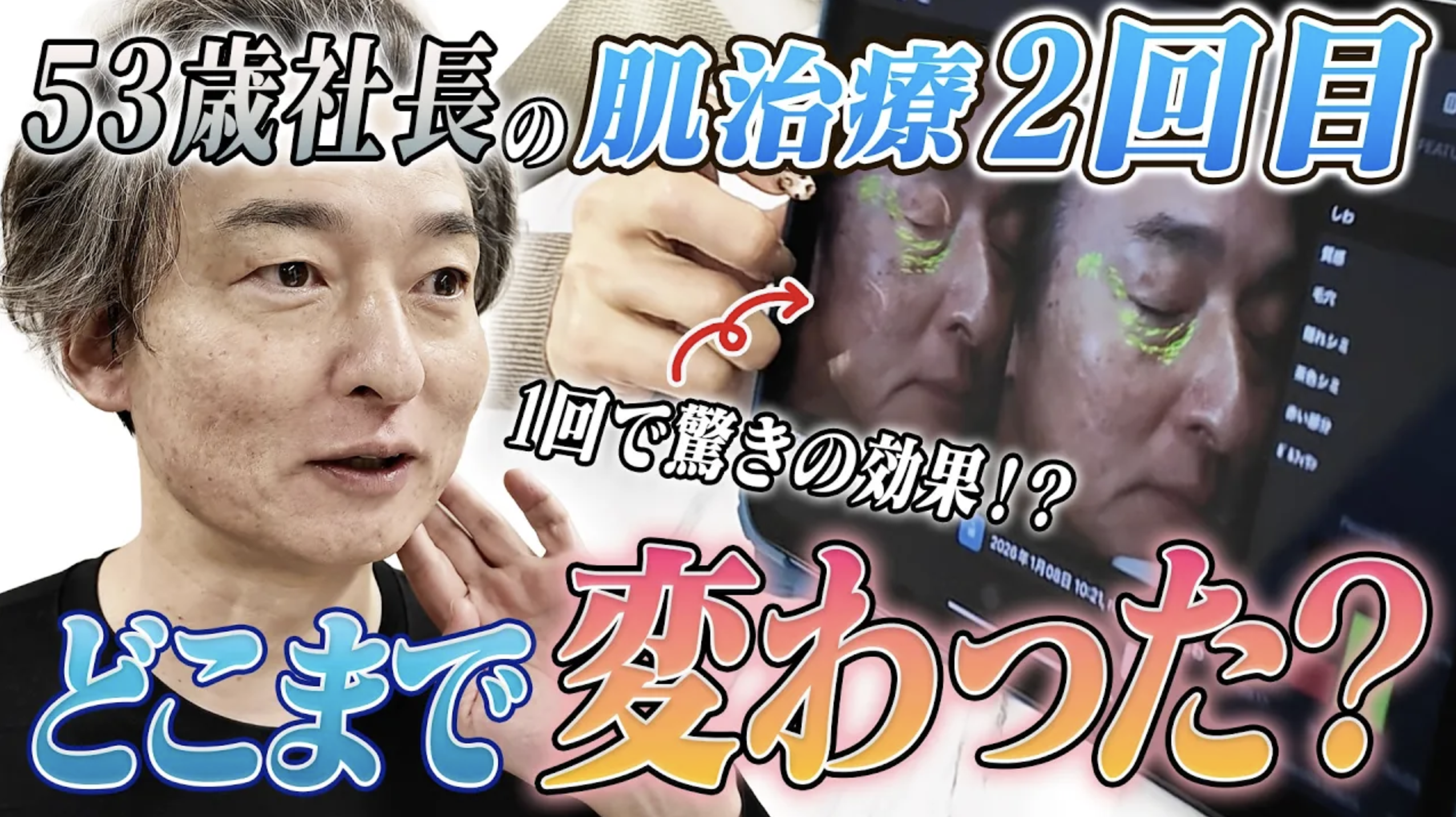 【実体験レポート】50代男性が美容皮膚科で若返りに挑戦！フォトフェイシャル2回目の劇的変化